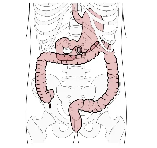 Zaburzenia wchłaniania tłuszczów objawy – nie ignoruj tych sygnałów