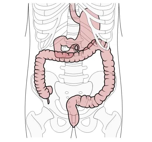 Zaburzenia wchłaniania tłuszczów objawy – nie ignoruj tych sygnałów