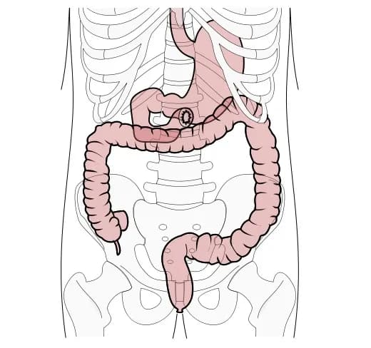 Zaburzenia wchłaniania tłuszczów objawy – nie ignoruj tych sygnałów